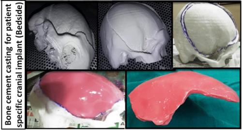 Bone Cement Casting for Patient Specific Cranial Implant